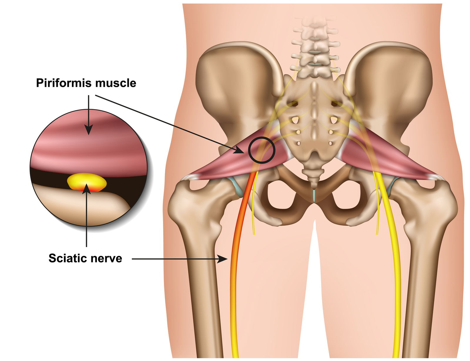 piriformis sindrom bolečine v kolku
