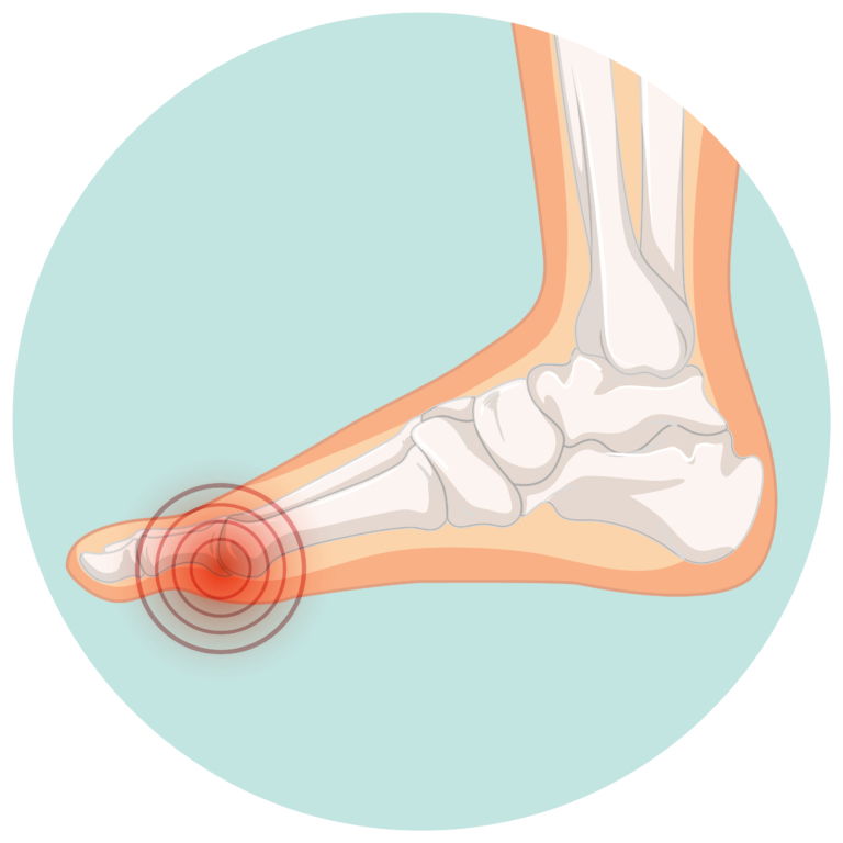 Hallux Valgus – Deformacija nožnega palca